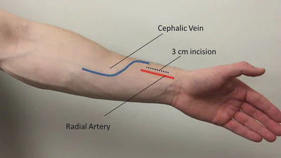 Δημιουργία αρτηριοφλεβικής fistula Brescia–Cimino για αιμοκάθαρση (βίντεο) featured image
